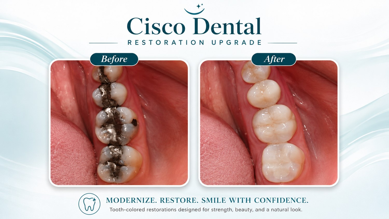 Before and after of lower molars: old dark fillings on the left, natural tooth-colored fillings on the right