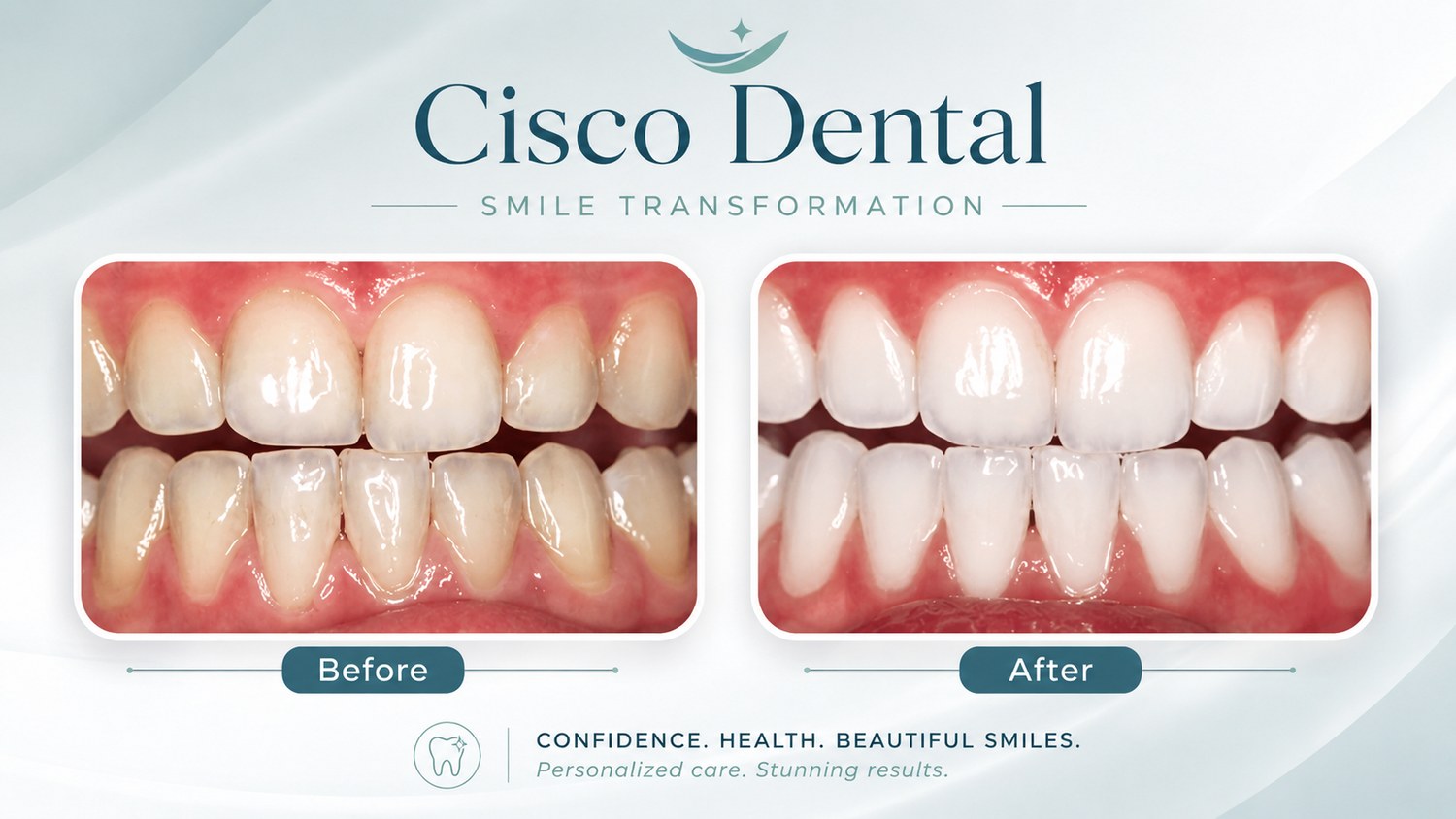 A smile before and after professional teeth whitening, with a noticeably brighter, more even shade after treatment